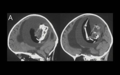 Doctors Discover 1-Year-Old’s Unborn Twin Inside Her Brain